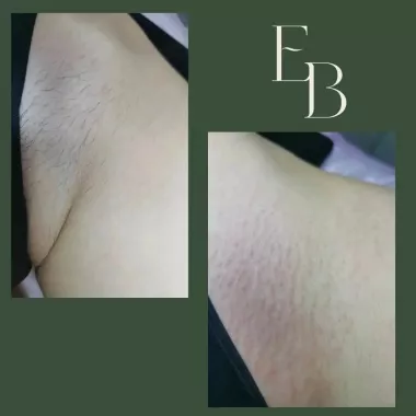Электроэпиляция "Epil Beauty".