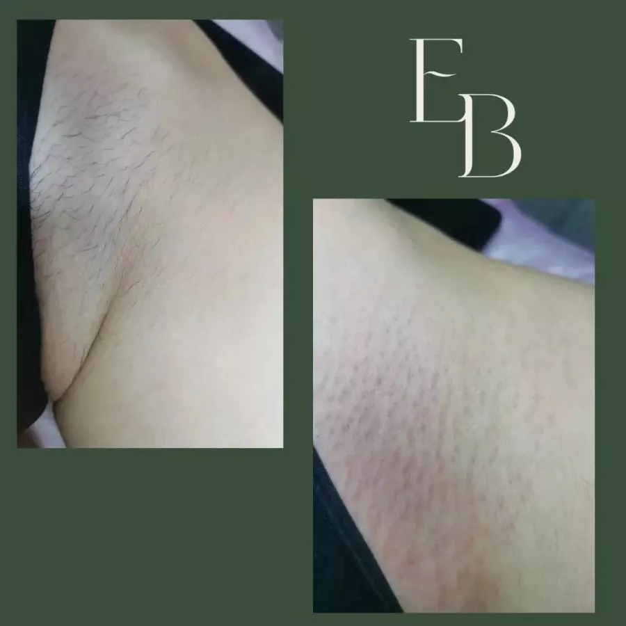 Электроэпиляция Epil Beauty в Ростове-на-Дону: Электроэпиляция, Эпиляция, Косметология, Депиляция,