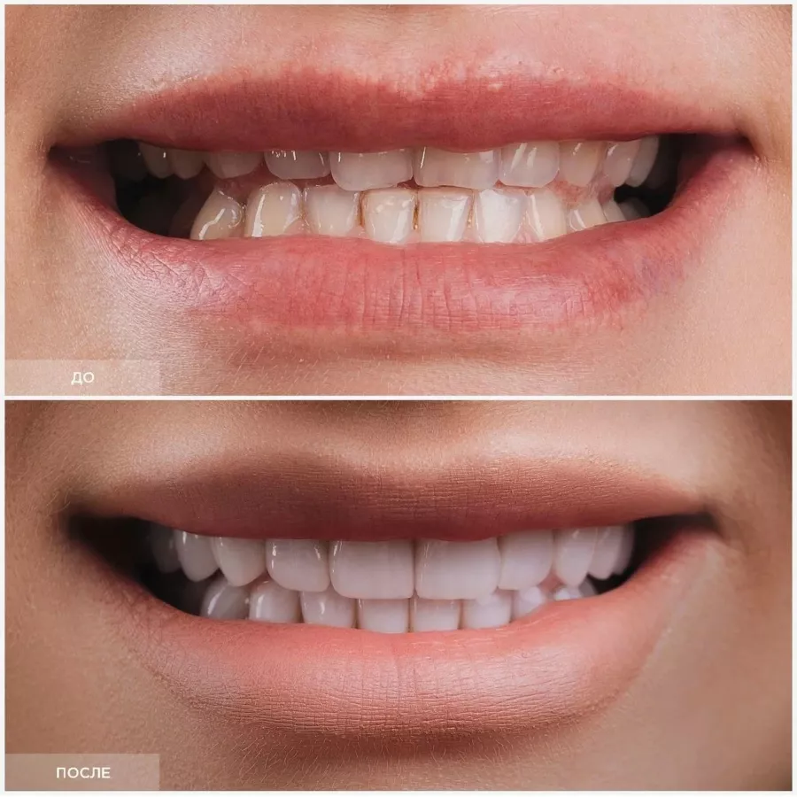 Стоматологическая клиника - Dental Lounge InWhite в Сочи: Лечение зубов, Виниры, Ортопедия, Установка имплантов, Veneers, Implantation,