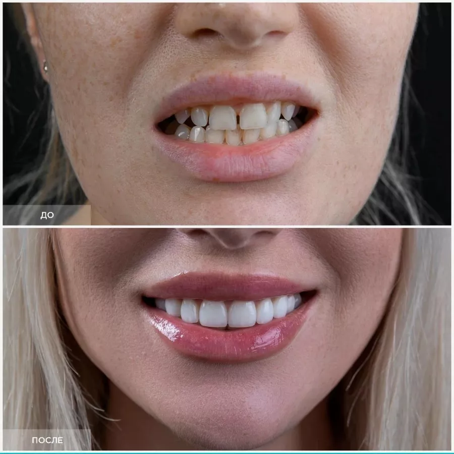 Стоматологическая клиника - Dental Lounge InWhite в Сочи: Лечение зубов, Виниры, Ортопедия, Установка имплантов, Veneers, Implantation,