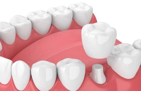 Стоматологическая клиника Ilham Dental Clinic в Дубаи: Стоматолог 🦷 , Стоматология , Медицина , Лечение зубов , Лечение кариеса , Зубы , Следить за здоровьем,