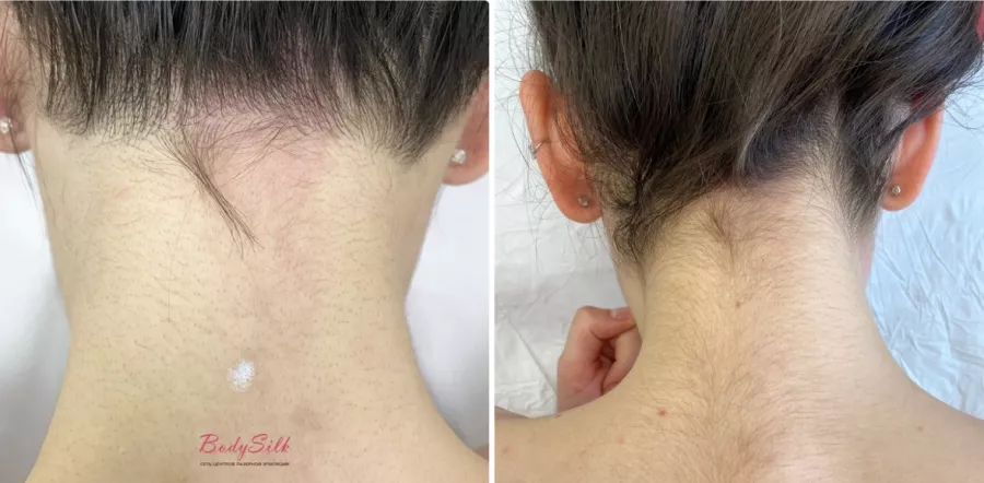 Лазерная эпиляция BodySilk в Ростове-на-Дону: Лазерная эпиляция, Депиляции , Эпиляция , Удаление волос, Косметология , Любить себя,